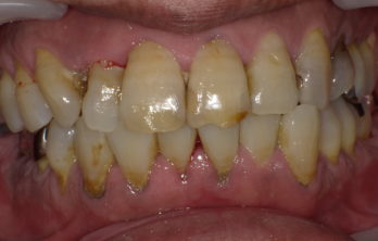 歯周病メンテナンス治療前