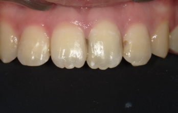 前歯の治療治療前