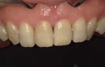 前歯の隙間が気になる治療後