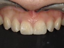 コンポジットレジンによる歯の隙間の閉鎖治療後