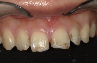 コンポジットレジンによる歯の隙間の閉鎖治療前