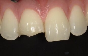 けがにより歯の破折の修復治療前