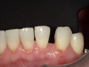 歯間離開の閉鎖治療前