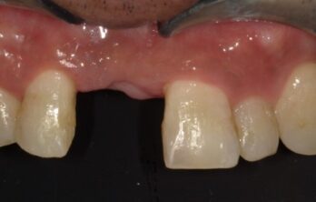 ダイレクトブリッジ治療前