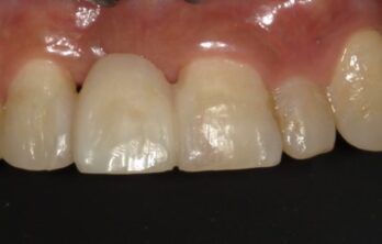 ダイレクトブリッジ治療後