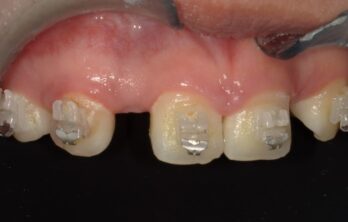 矯正治療とダイレクトブリッジのコラボ治療前