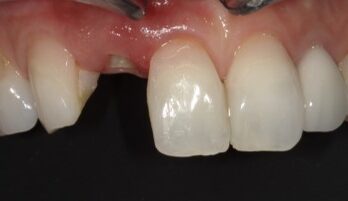 ダイレクトクラウン治療前