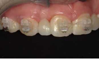矯正治療とダイレクトブリッジのコラボ治療後