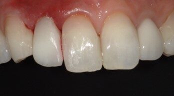 ダイレクトクラウン治療後