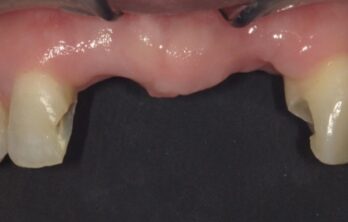 4年後のダイレクトブリッジ(2年目破折による修理)治療前