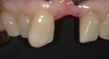 ダイレクトブリッジ5年半後治療前