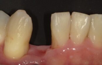下顎側切歯ダイレクトブリッジ治療前