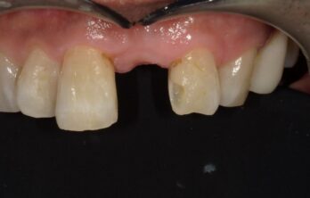 6年後のダイレクトブリッジ治療前