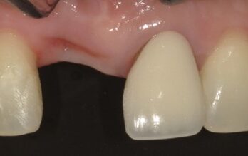 4年後のダイレクトブリッジ治療前