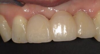 4年後のダイレクトブリッジ(2年目破折による修理)治療後