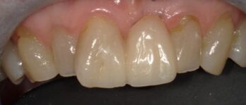 ダイレクトブリッジ5年半後治療後