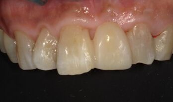 6年後のダイレクトブリッジ治療後