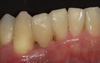 下顎側切歯ダイレクトブリッジ治療後
