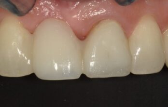 4年後のダイレクトブリッジ治療後