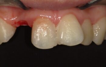 4年半後のダイレクトブリッジ治療前