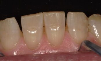 空隙閉鎖治療前