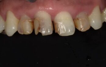 コンポジットレジン修復治療前