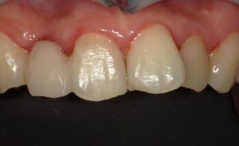 4年半後のダイレクトブリッジ治療後