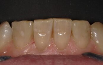 空隙閉鎖治療後