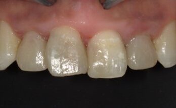 コンポジットレジン修復治療後