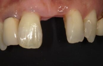 ダイレクトブリッジ治療前