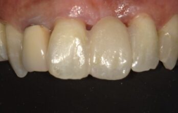 ダイレクトブリッジ治療後