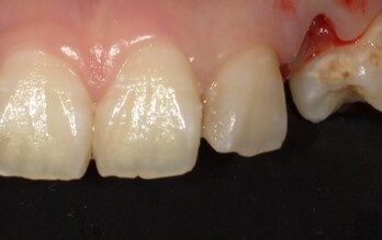 5年半後のダイレクトブリッジ治療前