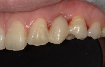 5年半後のダイレクトブリッジ治療後